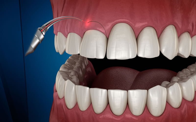 Diş Eti Hastalıkları • DentaVina Diş Kliniği Suadiye, Kadıköy