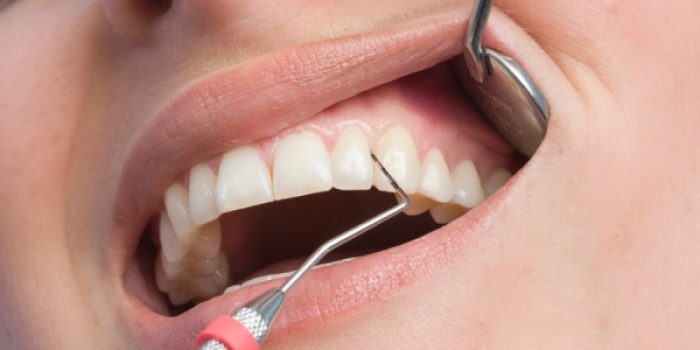 Diş Eti Hastalıkları • DentaVina Diş Kliniği Suadiye, Kadıköy